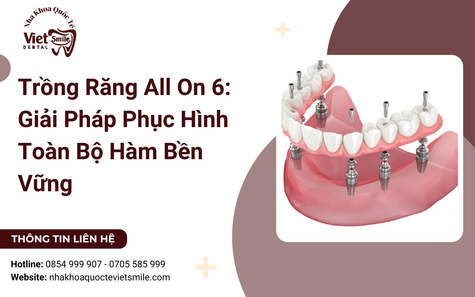 Trồng Răng All On 6: Giải Pháp Phục Hình Toàn Bộ Hàm Bền Vững