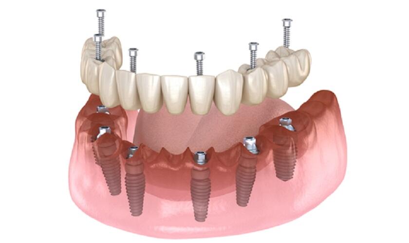 Trồng răng implant bắt vít toàn hàm All on 4, 6