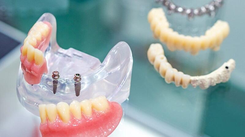 Trồng răng bắt vít có an toàn không?