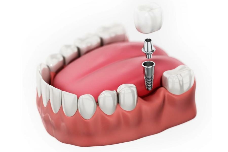 5 ưu điểm của phương pháp trồng răng implant