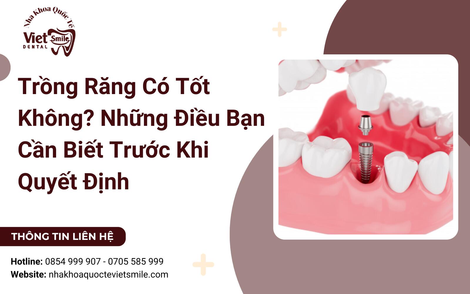 Trồng Răng Có Tốt Không? Những Điều Bạn Cần Biết Trước Khi Quyết Định