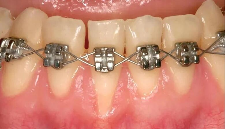 Mảng bám và cao răng